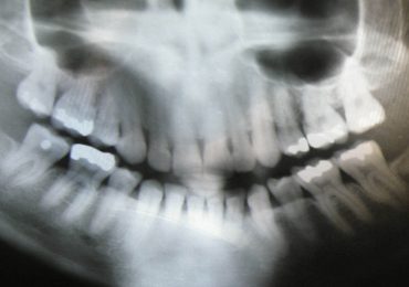 You May Not Need a Lead Apron for a Dental X-ray, a New Recommendation Says