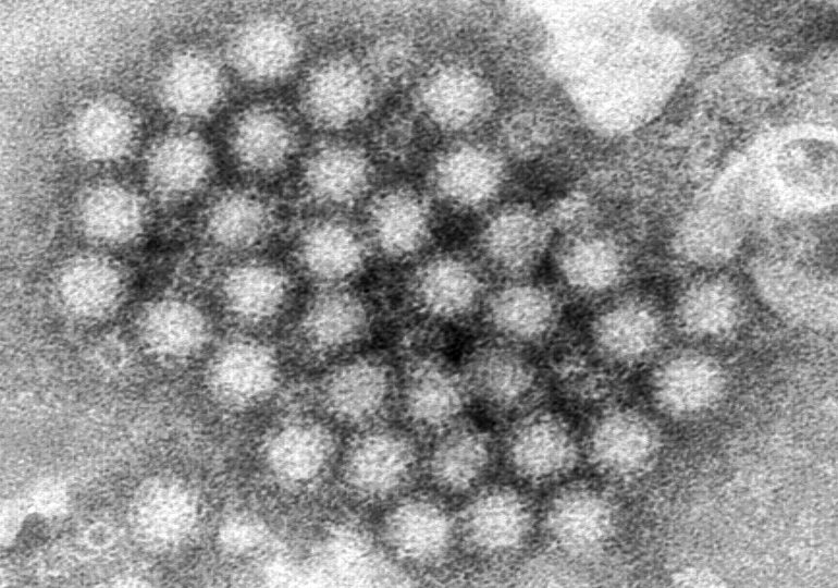 Norovirus Cases Are Rising. Here’s What to Know